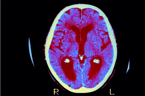 微生物感染导致阿尔茨海默病？饱受争议却值得关注