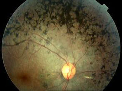 通过实验动物CRISPR技术改善遗传性失明